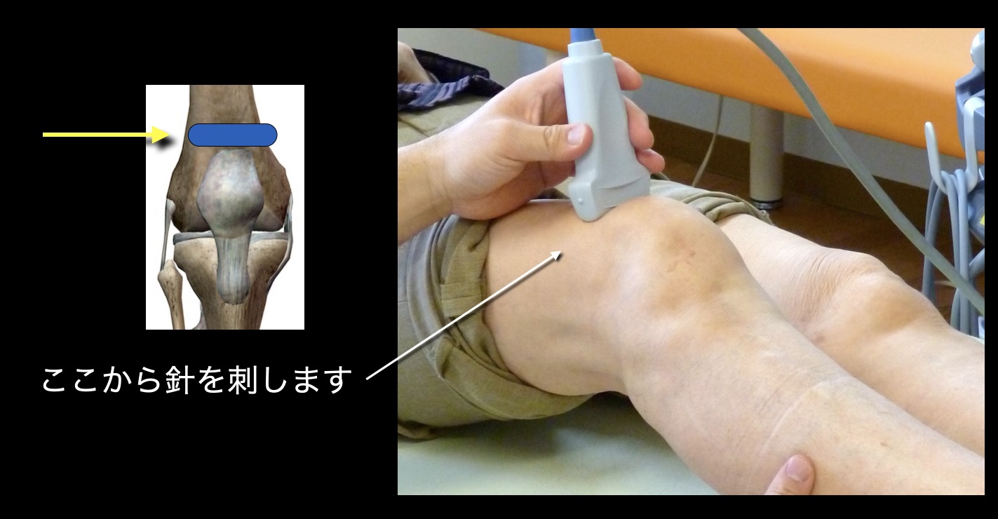 膝 ヒアルロン 酸 注射